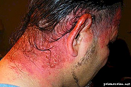 Alergija plaukų dažams - ar yra saugių dažų?