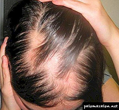Alopecia - ¿Qué es esta enfermedad? Causas, síntomas, tratamiento de la alopecia.