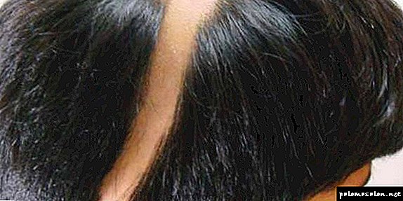Nidificação Alopecia: sintomas, causas, estágios