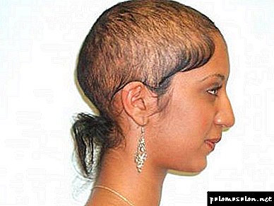 Alopecia: types, treatment in men and women