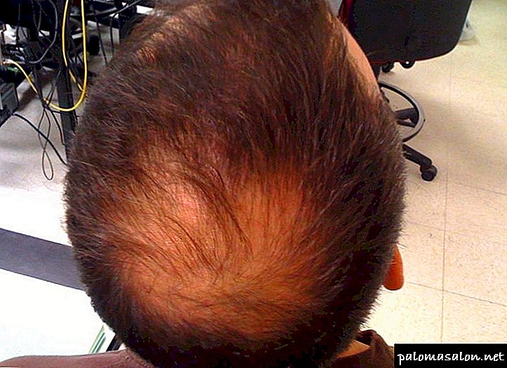 Alopecia - tipos, causas e tratamentos para a calvície