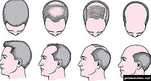 Causes and methods of treatment of androgenic alopecia in men