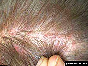 Sores on the head and in the hair: causes and treatment