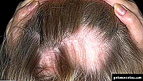 Seborrhoische Alopezie
