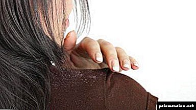 Sintomas e tratamento da dermatite seborréica do couro cabeludo com pomadas, preparações e xampus