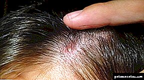 التهاب الجريبات: أسباب التهاب بصيلات الشعر وطرق العلاج
