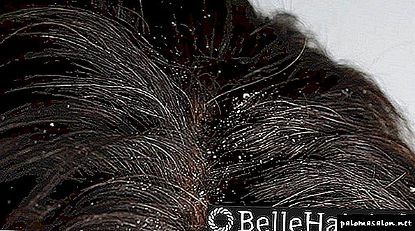 How to get rid of dandruff at home quickly and efficiently