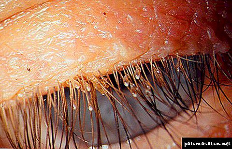 How to get rid of lice on the eyelashes