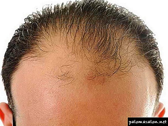 How to stop baldness in men