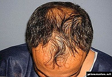 How to stop baldness in men folk remedies: proven recipes and the effect of treatment