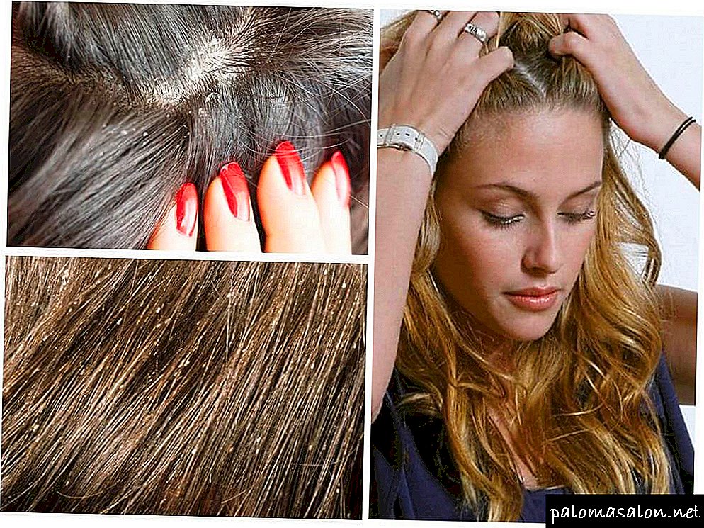 How to distinguish lice and nits from dandruff