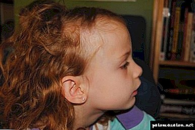 Фокална алопеция при деца: причини и методи на лечение