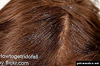 How to choose a suitable anti-dandruff remedy in pharmacies
