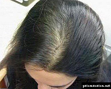 Que tipo de xampu é melhor da perda de cabelo? 4339 0