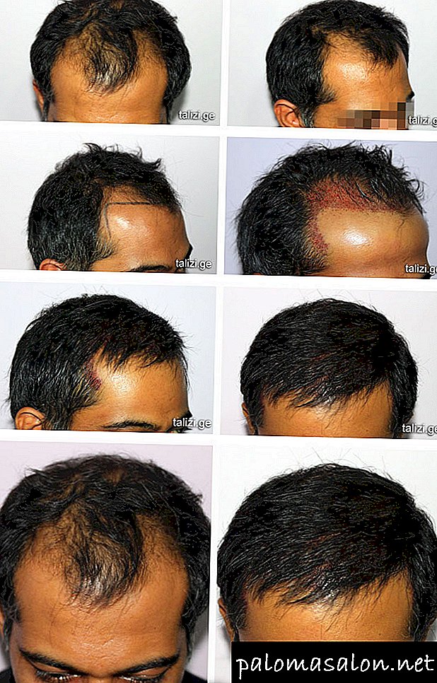 Trasplante de cabello: comparando métodos y evaluando resultados