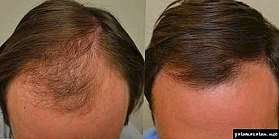 Treatment of alopecia with Minoxidil