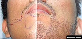 Vousy nerastú: čo robiť v 17, 18, 20, 24 a 30 rokoch? Transplantácia brady Fotografie