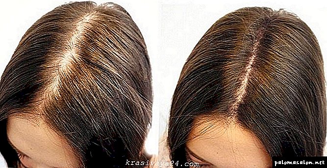 Plasmolifting of the scalp: a panacea or a waste of money?
