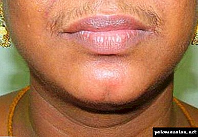 Chin hair in women: causes and 4 ways to remove