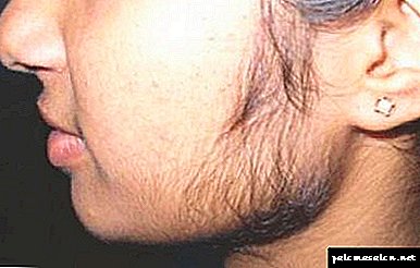 Increased hairiness in girls: causes and treatment, which doctor to contact