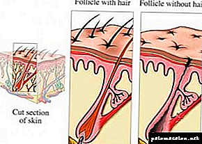 Punca dan rawatan alopecia autoimun (keguguran rambut)