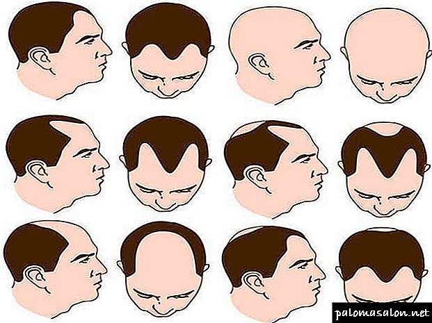 5 cara untuk mencegah rambut rontok pada pria
