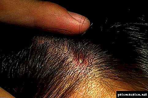 Why do acne appear on the head and how to treat it