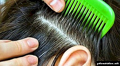 El procedimiento para determinar la causa de la calvicie o qué pasar para las pruebas de pérdida de cabello.