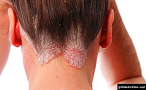 What is psoriasis of the scalp and how to cope with it? Effective treatments, care tips