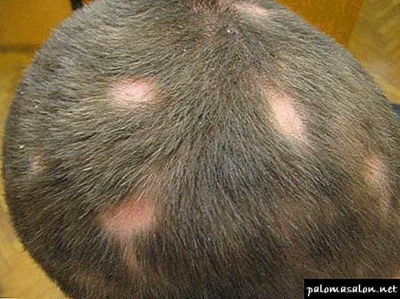 Baldness in syphilis
