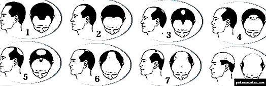 5 besten Mittel gegen Glatzenbildung