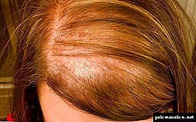 Phải làm gì với mái tóc hiếm: chúng tôi điều trị, phục hồi và cho khối lượng!