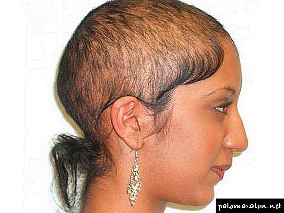Alopecia (alopecia) - apa penyebab, jenis dan tahapan pada pria dan wanita