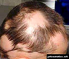 Les cheveux tombent chez un enfant de 8 ans causes et traitement