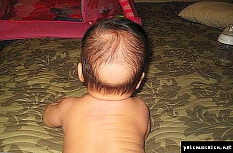 Rụng tóc ở trẻ em: nguyên nhân và phải làm gì