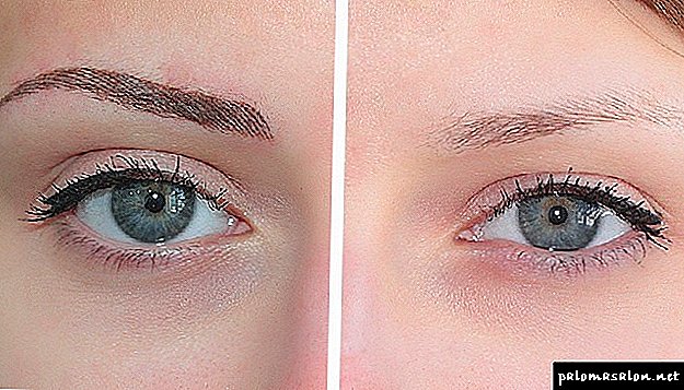 Laser eyebrow tattoo removal - preparation and carrying out the procedure, contraindications and prices